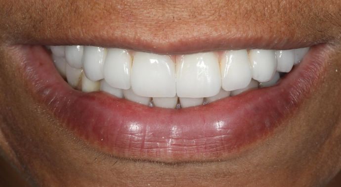 After veneers procedure